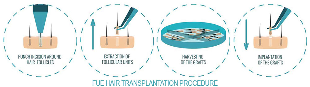 neograft hair transplant steps